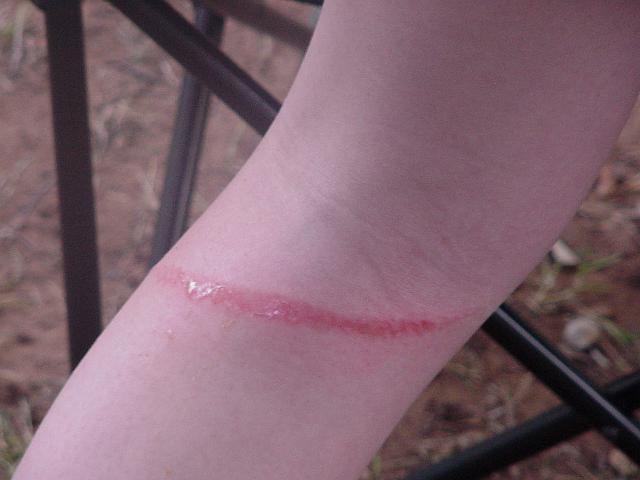 Rope burn on Gretchen's leg 2.jpg